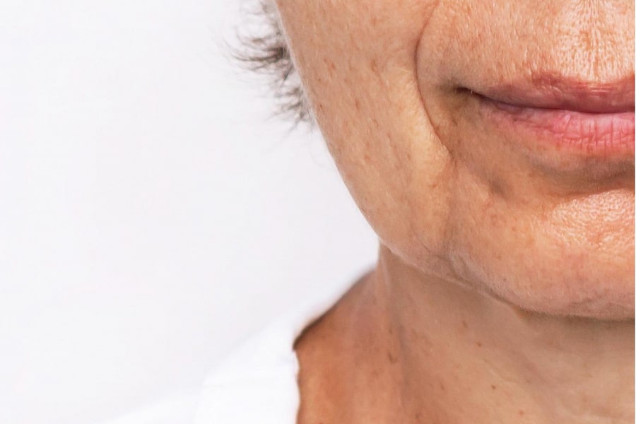 Фото работы RF омоложение лица и шеи на аппарате Indiba 2 Мини