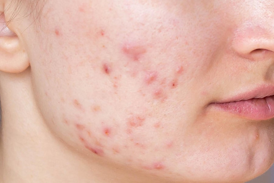 Фото работы Лечение акне на аппарате Indiba 2 Мини