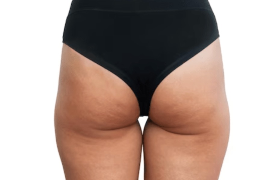 Фото работы Избавление от целлюлита аппаратом Indiba 2 Мини