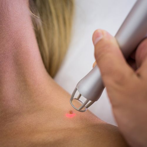 Удаление папиллом