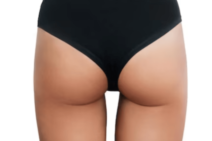 Фото работы Избавление от целлюлита аппаратом Indiba 1 Мини