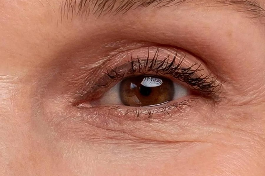 Фото работы RF лифтинг глаз с помощью аппарата Indiba 1 Мини