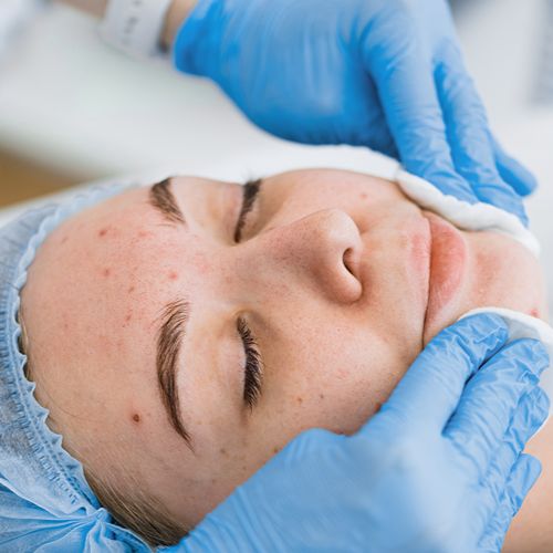 Лечение акне