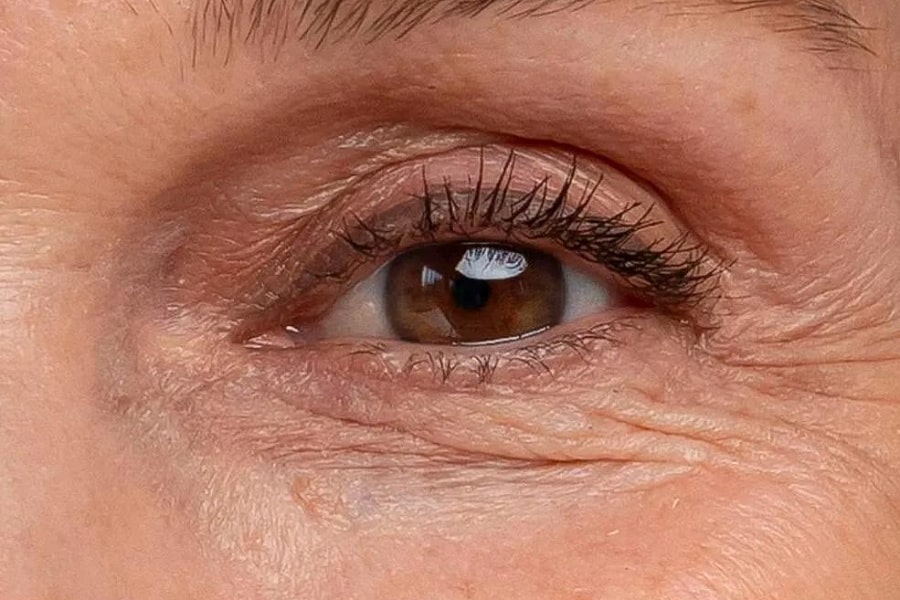 Фото работы RF лифтинг глаз с помощью аппарата Indiba 2 Мини