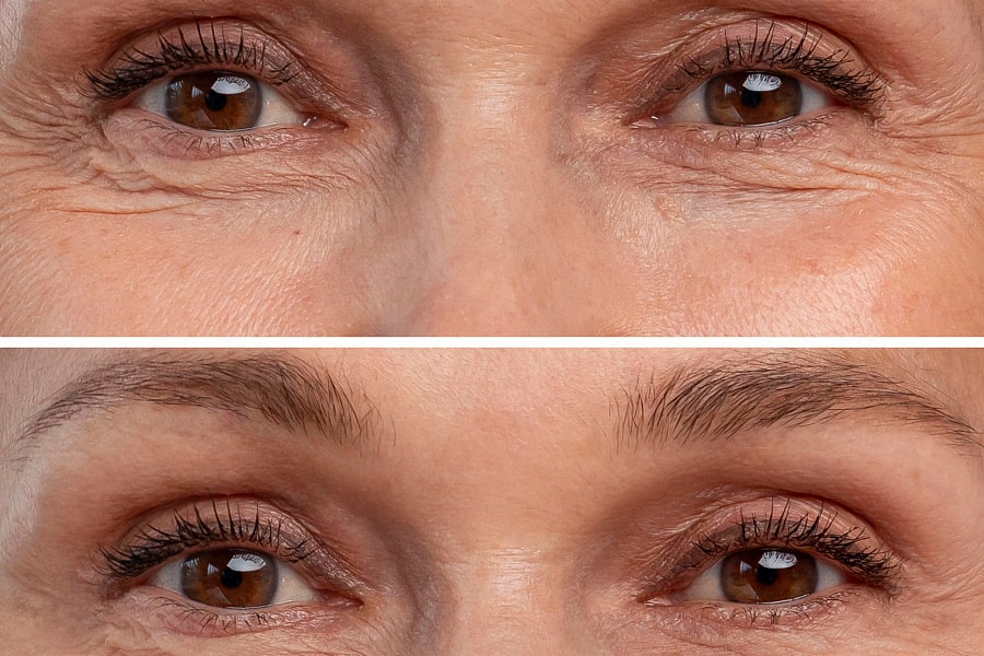 Фото работы RF лифтинг глаз с помощью аппарата Indiba 3 Мини