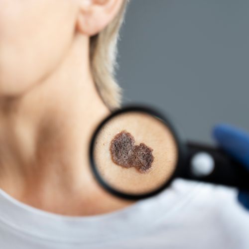 Удаление гемангиомы