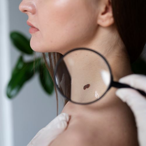 Удаление кератомы